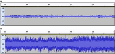 Pressing Crowd Noise Impairs the Ability of Anxious Basketball Referees to Discriminate Fouls